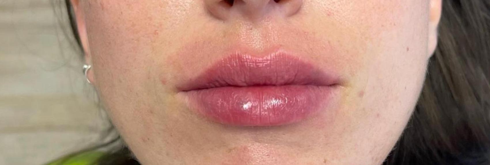 tratamiento estética labios torrent